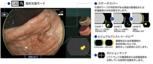 人工知能(AI)大腸内視鏡システム